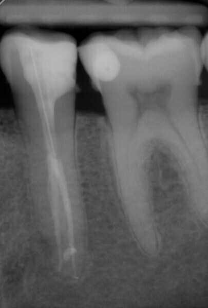 Fig. 7c: Radiograph after three years. The patient attended for professional dental cleaning, and some calculus can be seen on the image.