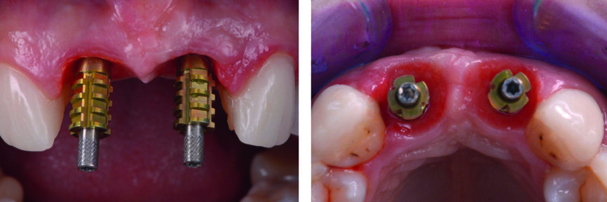 Fig. 27 : Empreinte au niveau des implants (technique pick-up). 