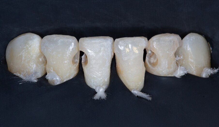 Fig. 3: Appearance of the teeth after caries removal.