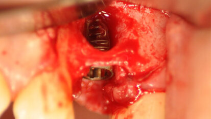 Posizionamento immediato di un impianto Neoss ProActive Edge in osso compromesso