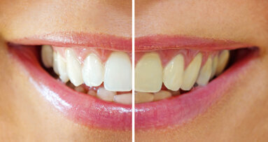 Neue SSO-Broschüre zum Thema Bleaching