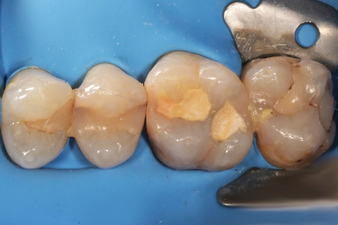 Фиг. 6: Зъбът две седмици по-късно. Бе поставен кофердам.