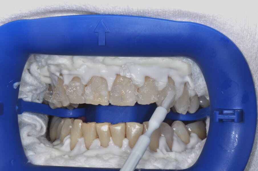Fig. 2 - Distribuzione omogenea del gel con pennello.