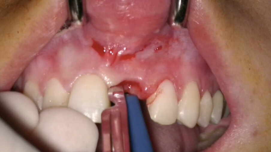 Fig. 14_Disegno del lembo nei casi di edentulia parziale frontale.
