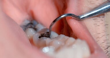 Europees Parlement verbiedt amalgaamvullingen