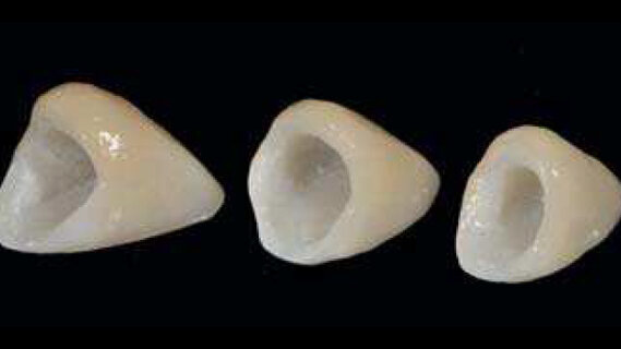 Entre BOPT et BTA : Une étude de cas sur le remodelage du contour gingival de restaurations dento-portées au moyen de couronnes provisoires en résine.