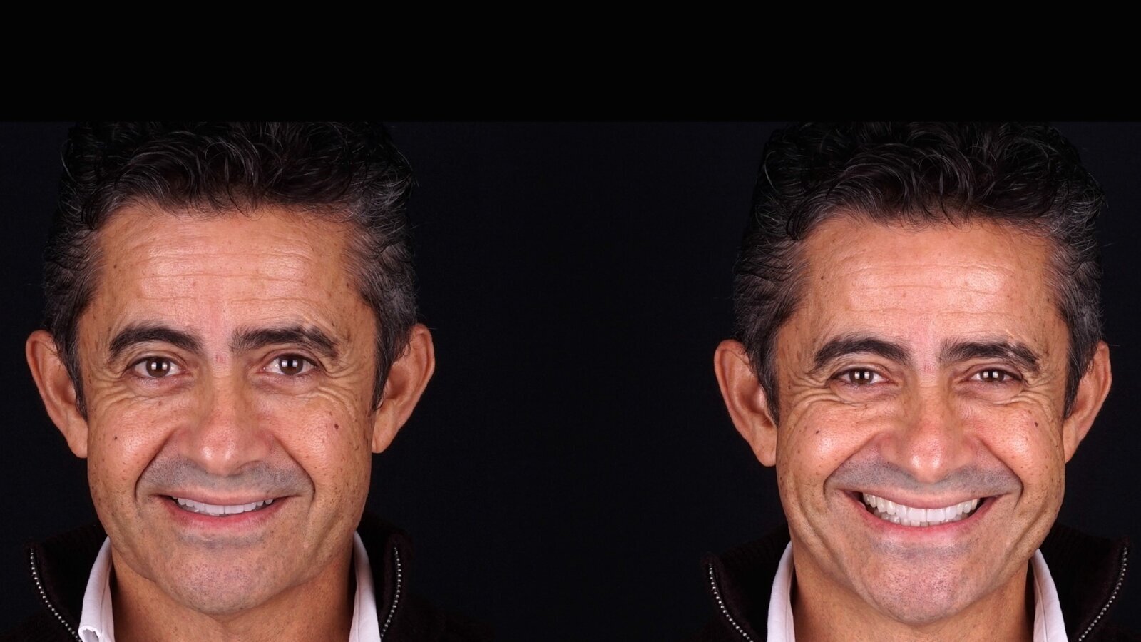 Colocación de restauraciones cerámicas adhesivas en la zona estética (2)