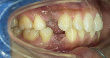 What to consider when caring for partially dentate patients