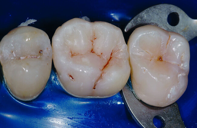 Figs. 30 et 31 :
Vue après polissage de la restauration. Le champ opératoire peut alors être déposé afin de réaliser les derniers réglages occlusaux.