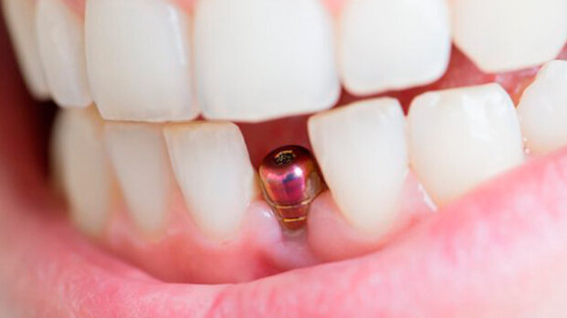 Una Consensus Conference europea di aggiornamento sugli impianti dentali