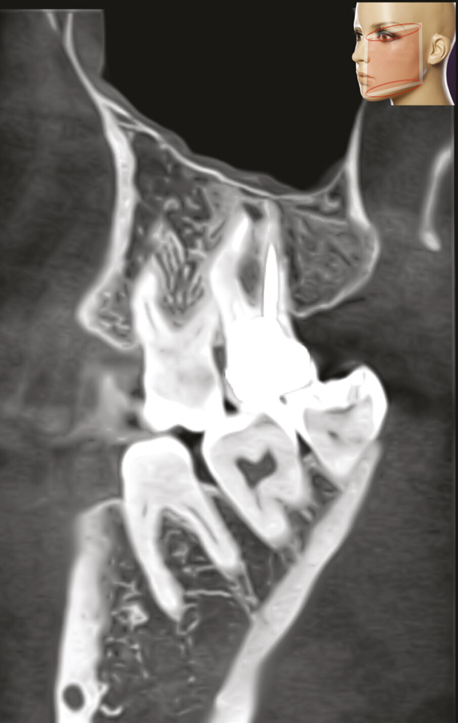 Fig. 2c - La CBCT mostra l’inclinazione distale della radice distovestibolare del primo molare.