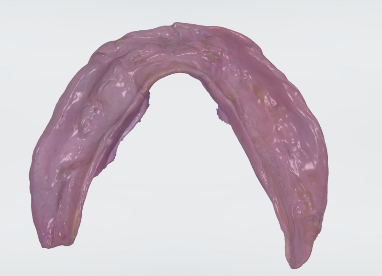 Fig. 14: Scanned mandibular denture with functional impression in situ.