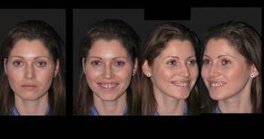 El embellecimiento de sonrisas con ácido hialurónico