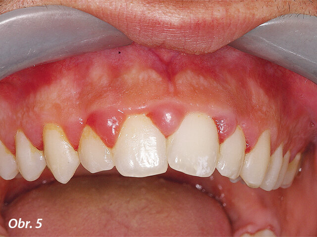 V druhé kazuistice se jednalo o dospívajícího pacienta s hyperplastickou gingivitidou v horním frontálním úseku.