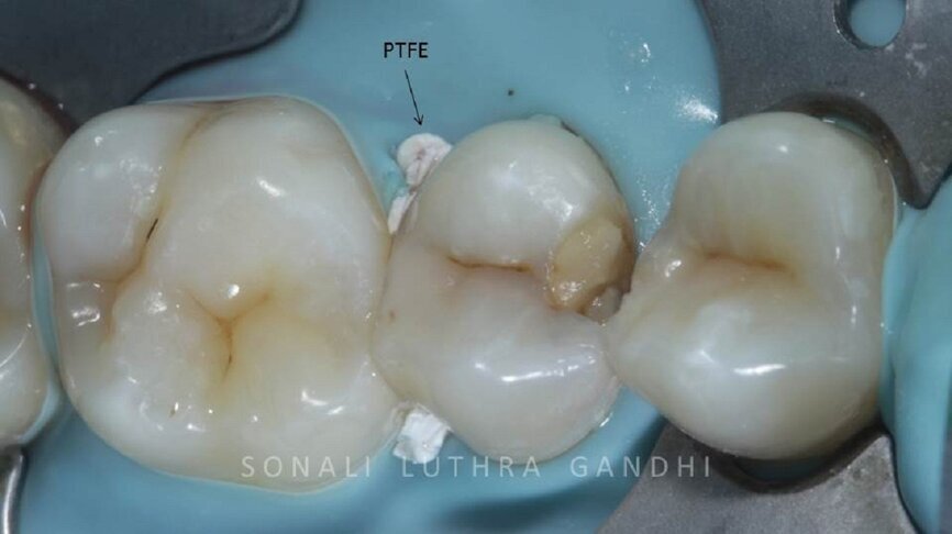 Figure 2 Isolation achieved with Rubber Dam & PTFE tape