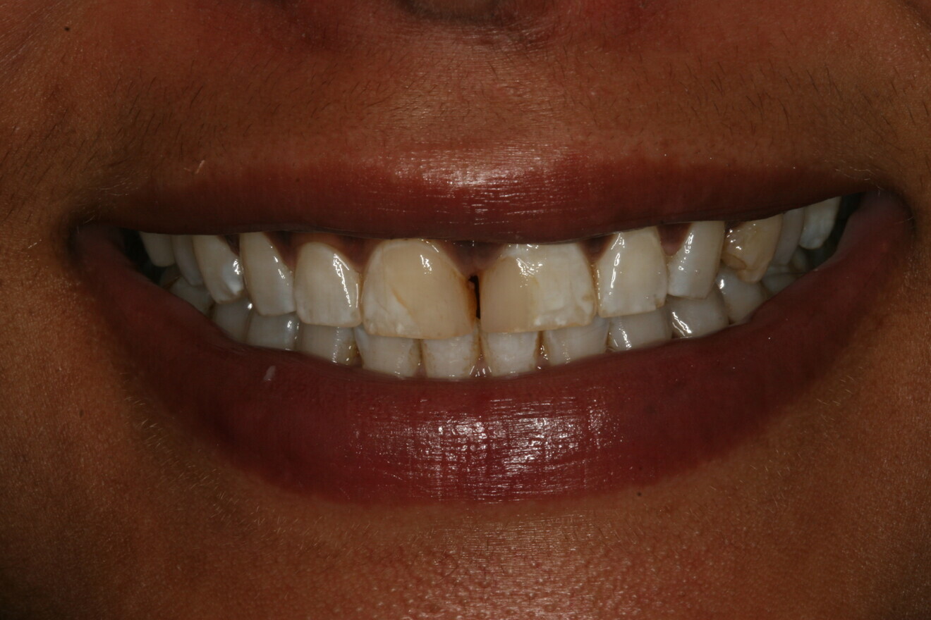 Fig. 1: Pre-op full smile.