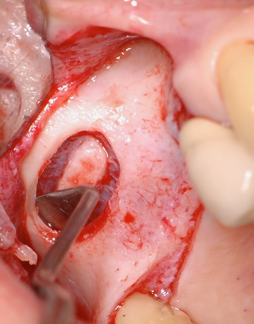 Figg. 6, 7_Fasi dello scollamento manuale della membrana Schneideriana.