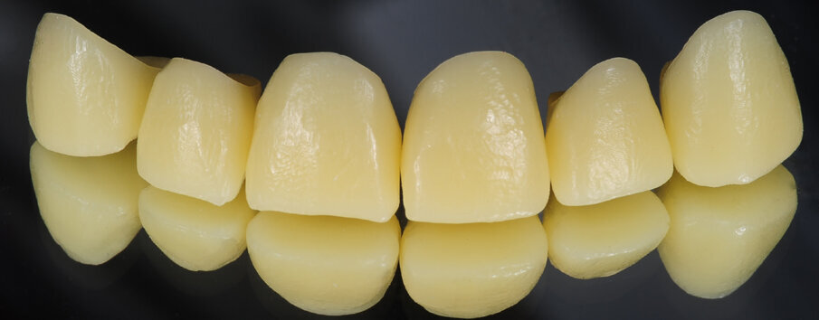 Fig. 10: CAD/CAM-manufactured 09 — ProArt CAD Wax yellow disc full-contour wax crowns