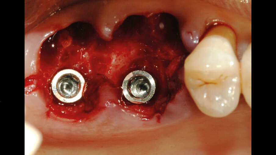 Fig. 3 - Inserimento dei due impianti 4.3 x 10 mm (IDI evolution Tiger) all’interno dello spazio alveolare.