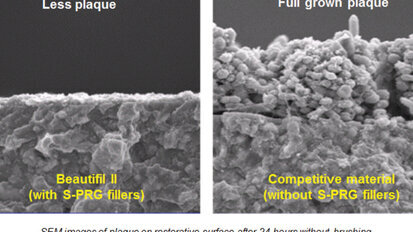 Beautifil II, un composite bioactivo y biomimético que libera fluoruro