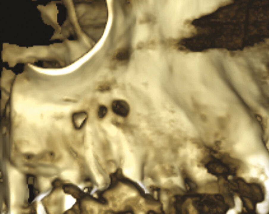 Fig. 1c - La CBCT mostra il riassorbimento dell’osso corticale adiacente la radice distovestibolare.