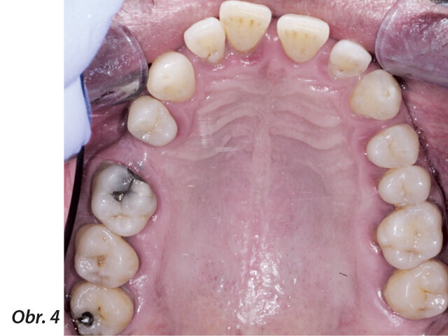 Obr. 1–5: Fotografi cká dokumentace počátečního stavu před parodontologickým ošetřením