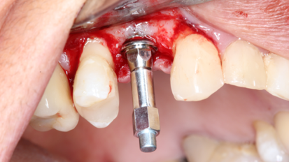 Comparative Study — of implant placement torque and resonance frequency analysis on the implant and abutment