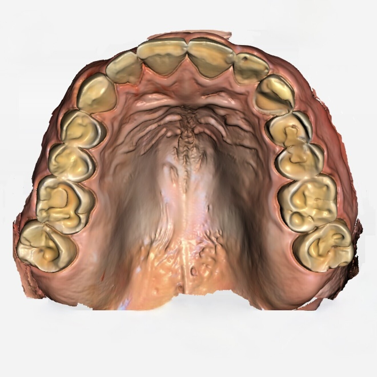 Fig. 3a: Digital scan of the initial situation. Upper jaw.