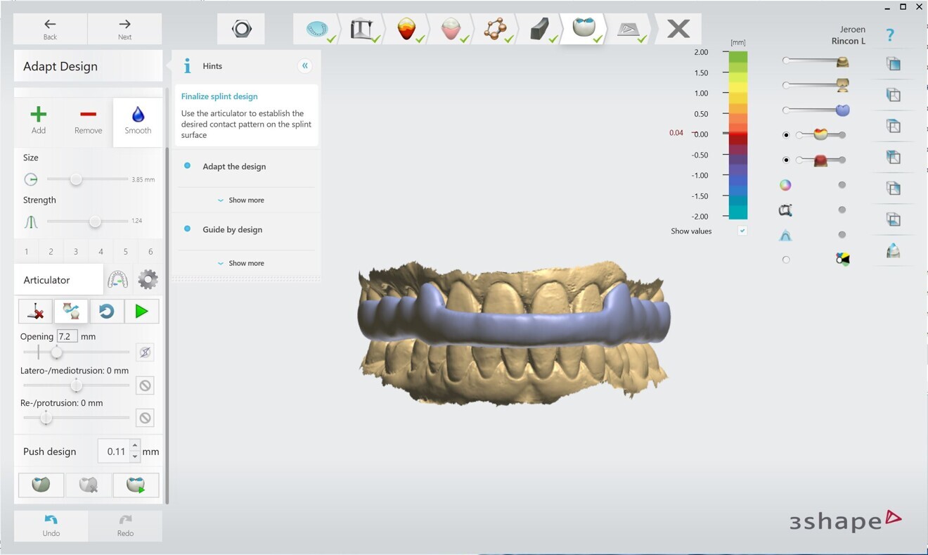 Fig. 5: All splints designed in our laboratory have canine extensions for additional retention and to help avoid tipping during articulation.