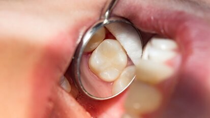 Glass hybrids versus composite: Efficacy and cost-effectiveness in a multicentre clinical study Glass hybrids versus composite: Efficacy and cost-effectiveness in a multicentre clinical study