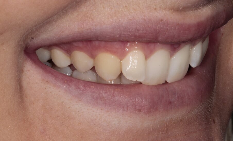 6. Initiële situatie, rechter vooraanzicht