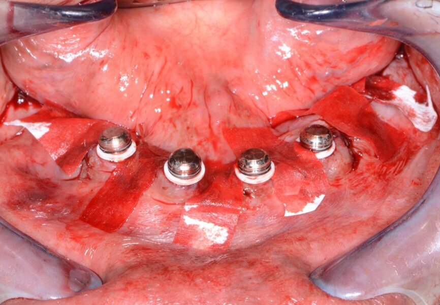 Fig. 17: Overdenture housings ready for the pick-up impression.