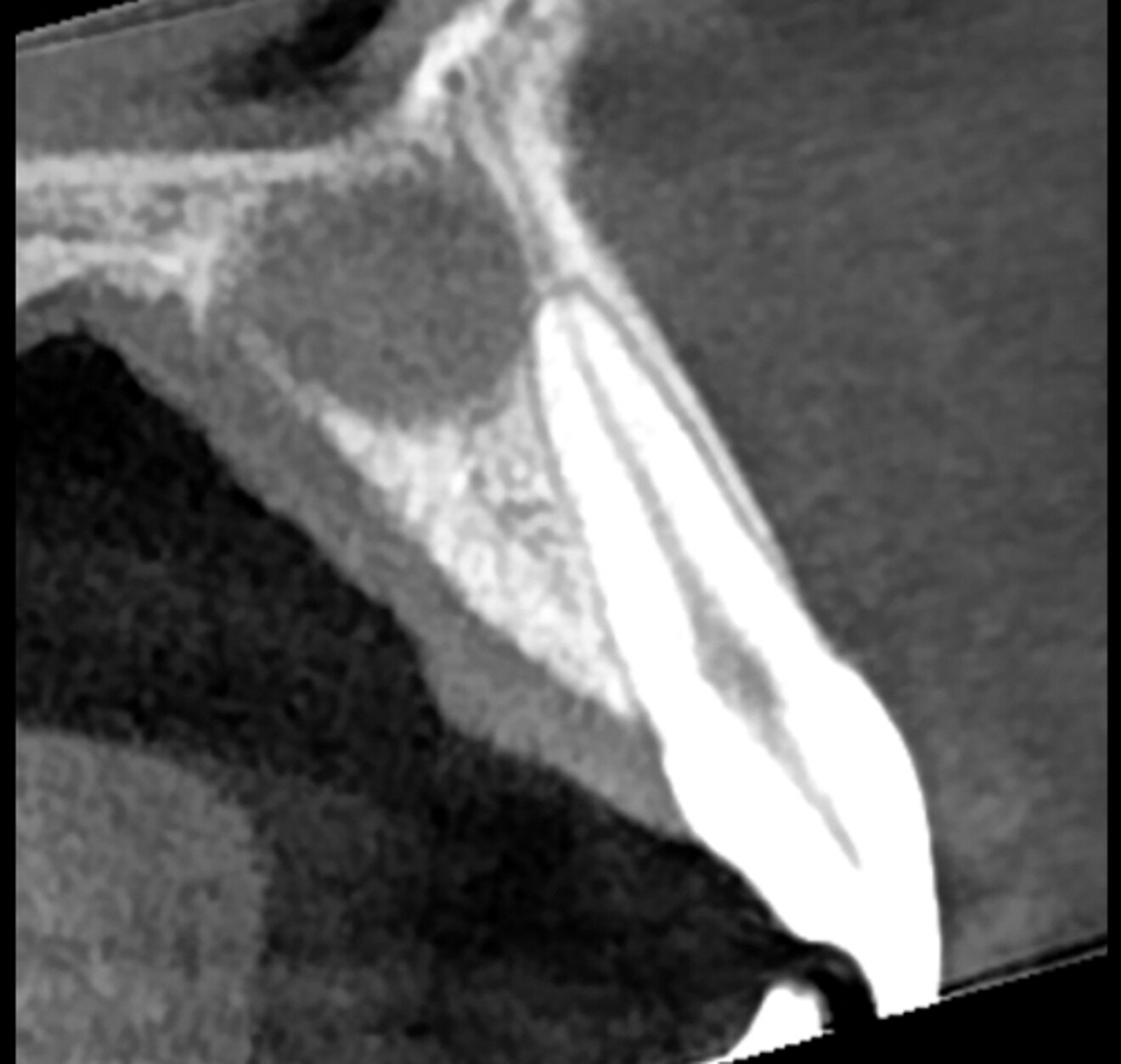 Fig. 2b: Artificial intelligence-enhanced image showing the nerve entering the central incisor.
