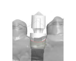 Neoss Digital Workflow with 3Shape