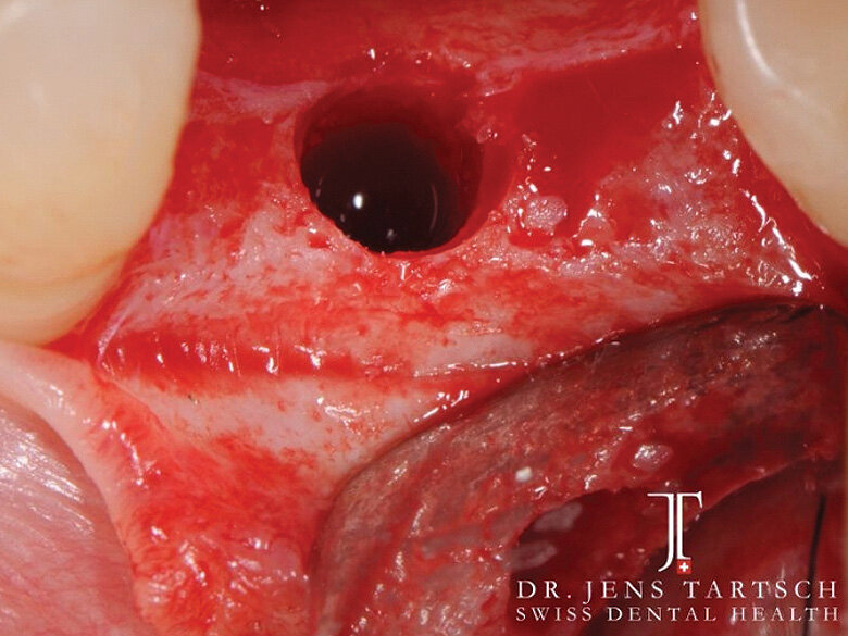 Fig. 3: Prepared implant bed after thread cutting. (Photo: Jens Tartsch, DMD)