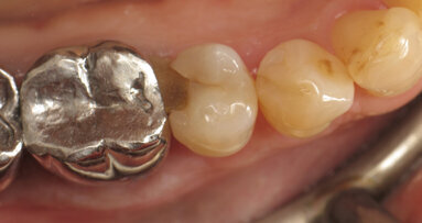 Restauration de classe II avec du composite thermo visqueux