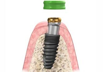 Stern SNAP Angled Overdenture Implant Abutment System