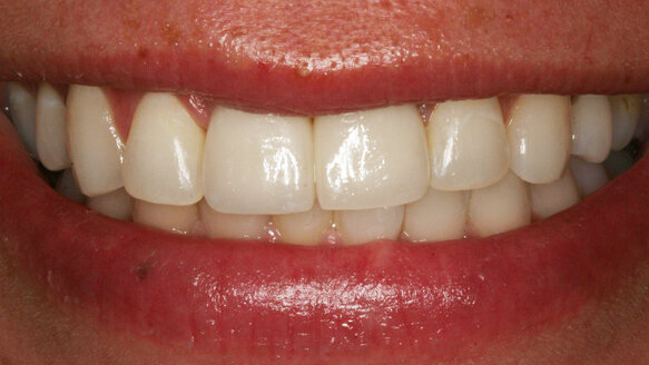 Management of two implants in the esthetic zone