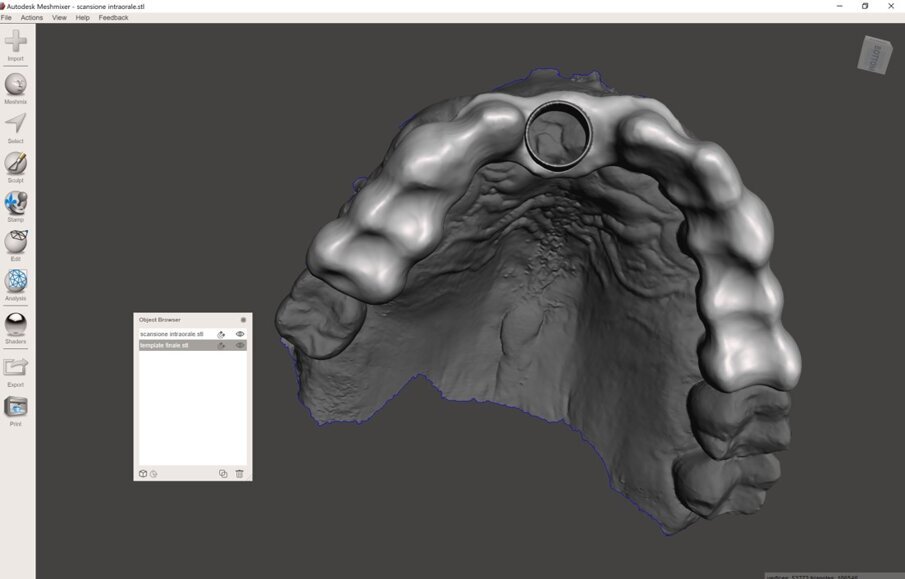 Fig. 8_Disegno della dima chirurgica con software open-source (Meshmixer, Autodesk), visione occlusale.