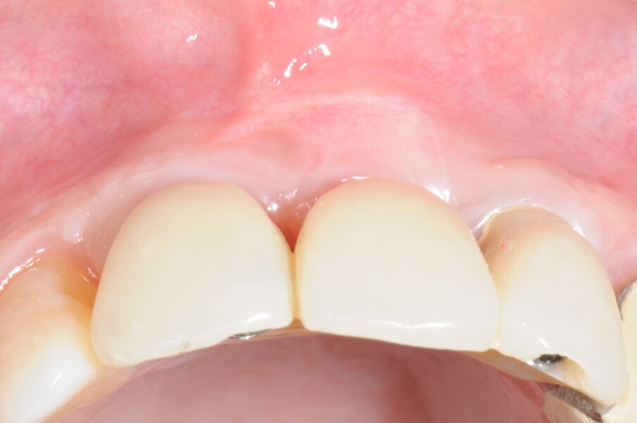 Figg. 24a, 24b - Protesi provvisoria in visione occlusale e frontale.