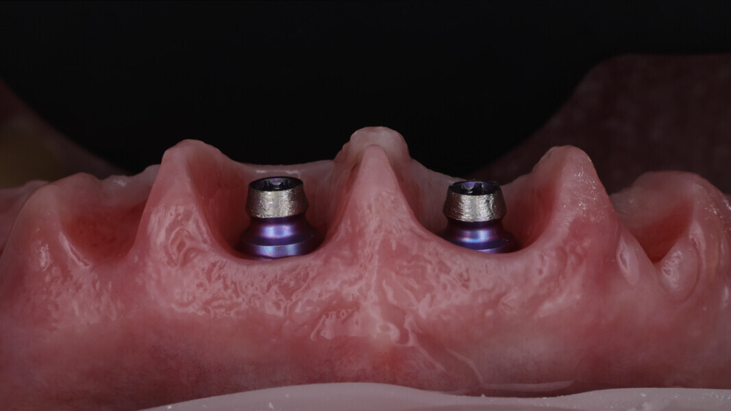 Fig. 30: How to transfer soft-tissue information to the definitive restoration: use the temporary restoration the same way we used the segmentation.