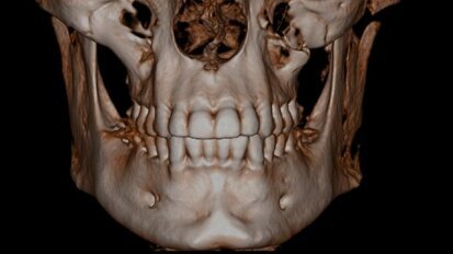 Résultats du sondage Cone beam