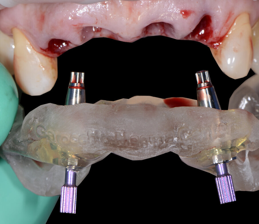 Fig. 35 - Rimozione dima protesica.