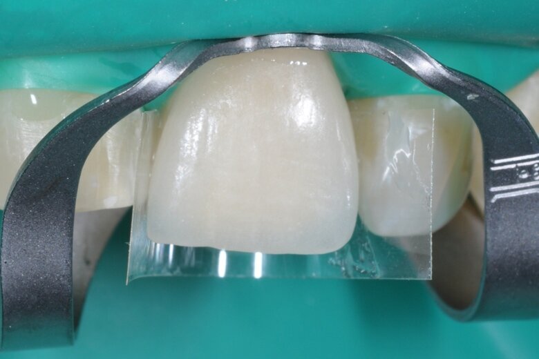 Fig. 21 Veneer fitted and excess material removed.