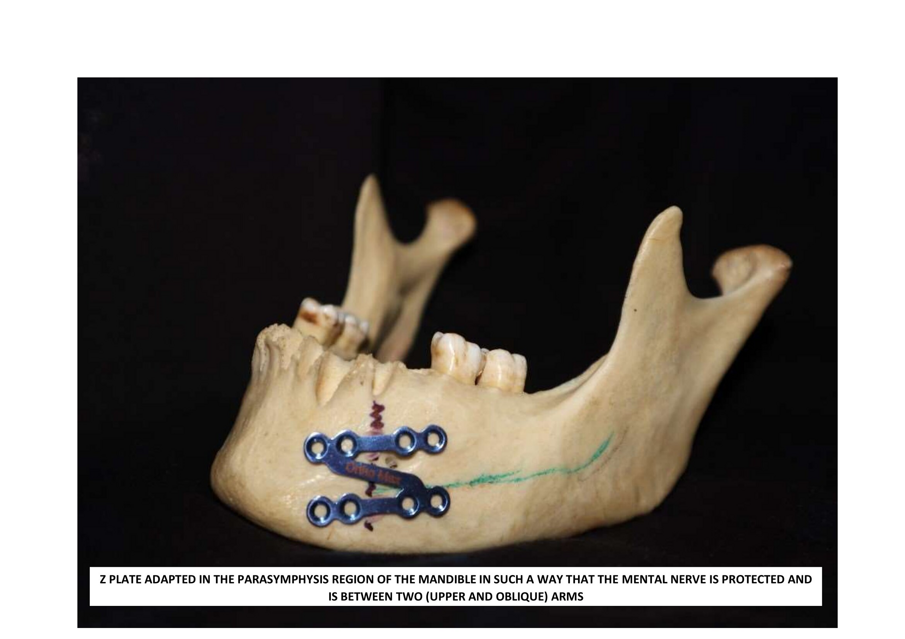 z plate mental nerve