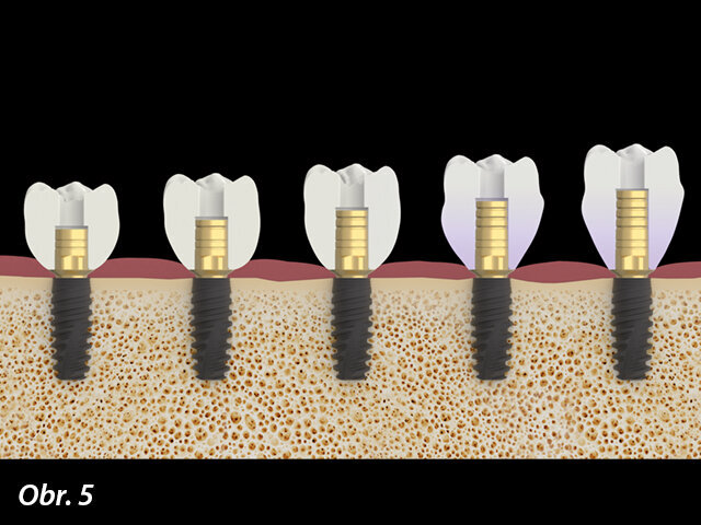 Titanové báze K85 je možné individuálně zkrátit za účelem optimálního uzpůsobení délce zubu.