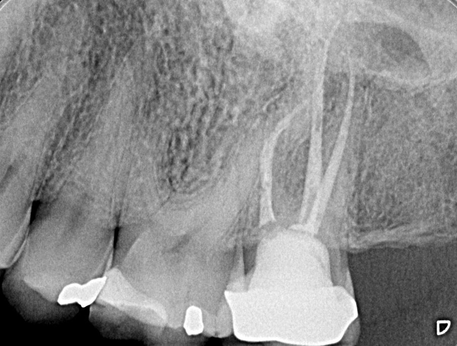 Fig. 2a - Radiografia preoperatoria del secondo molare superiore di sinistra. La paziente lamenta dolore alla masticazione su questo dente, trattato endodonticamente pochi mesi prima. La stessa viene indirizzata con la specifica richiesta di eseguire la terapia chirurgica e di non aprire una cavità d’accesso, allo scopo di non sciupare la “nuova” corona ceramica da poco cementata.