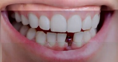 EFP публикува ръководство за превенция и лечение на периимплантните заболявания