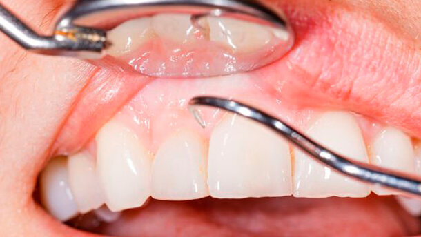 Tasche parodontali profonde mettono a repentaglio la salute orale