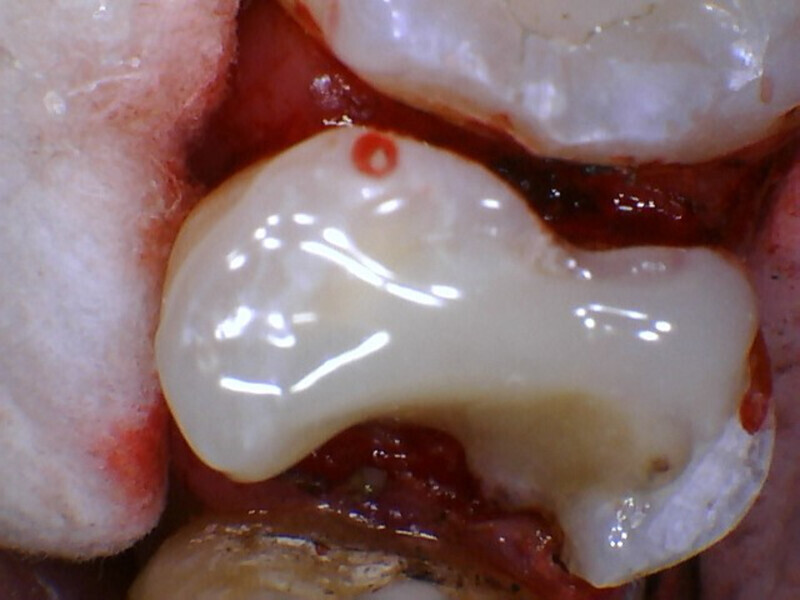 Fig. 7: Placement of a core of RelyX Unicem resin over the GC FujiCEM, placed to cover the pulpal exposure, in preparation for a crown.